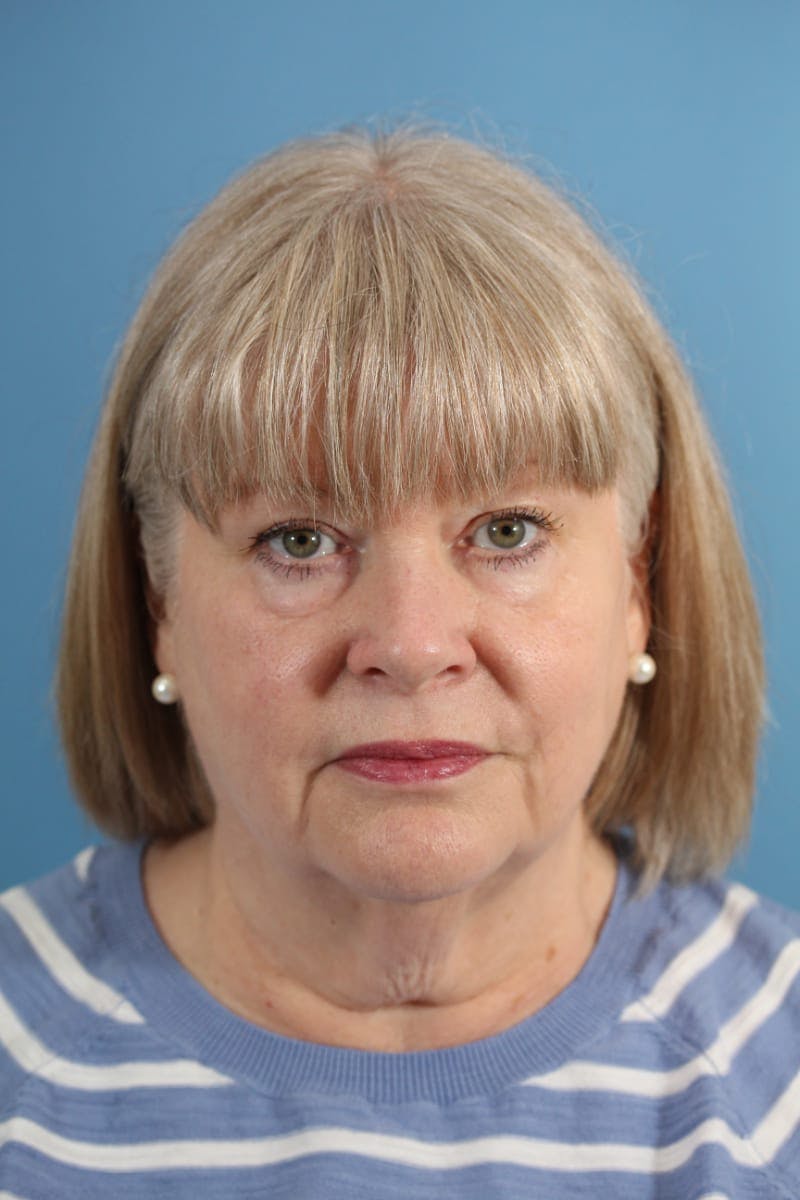 Neck Lift