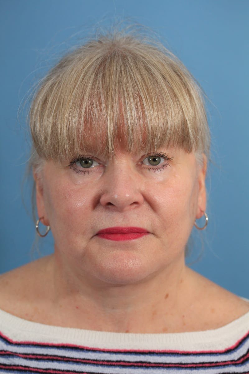 Neck Lift
