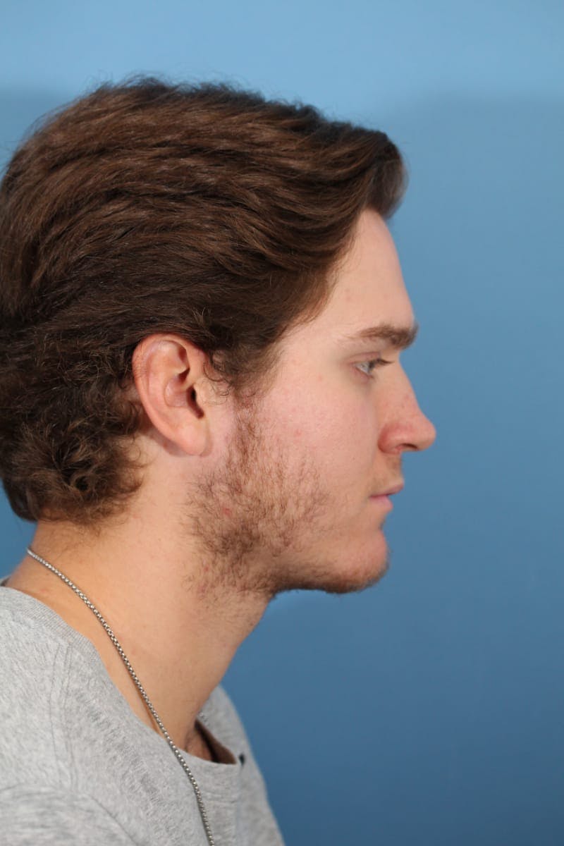 Rhinoplasty Before & After Gallery - Patient 36550407 - Image 5