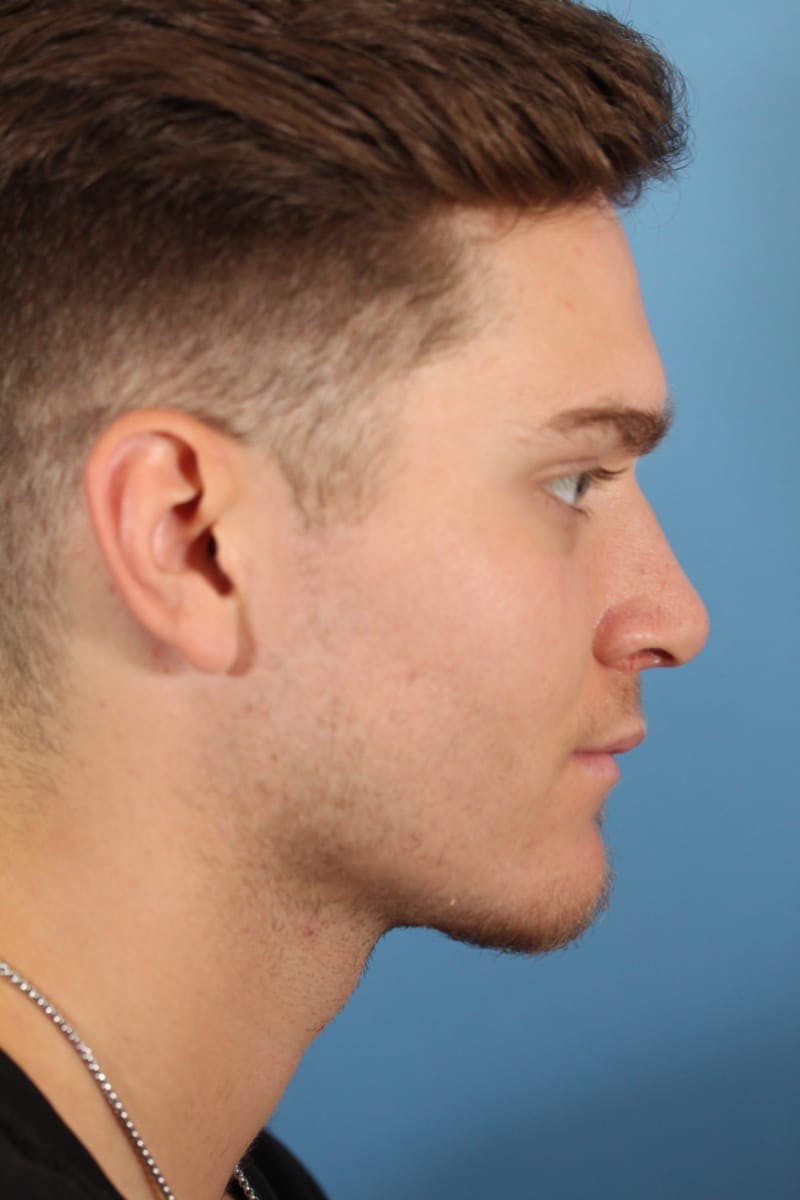 Rhinoplasty Before & After Gallery - Patient 36550407 - Image 6