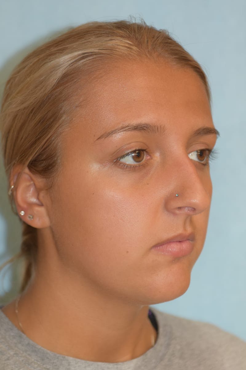 Rhinoplasty Before & After Gallery - Patient 36550413 - Image 3