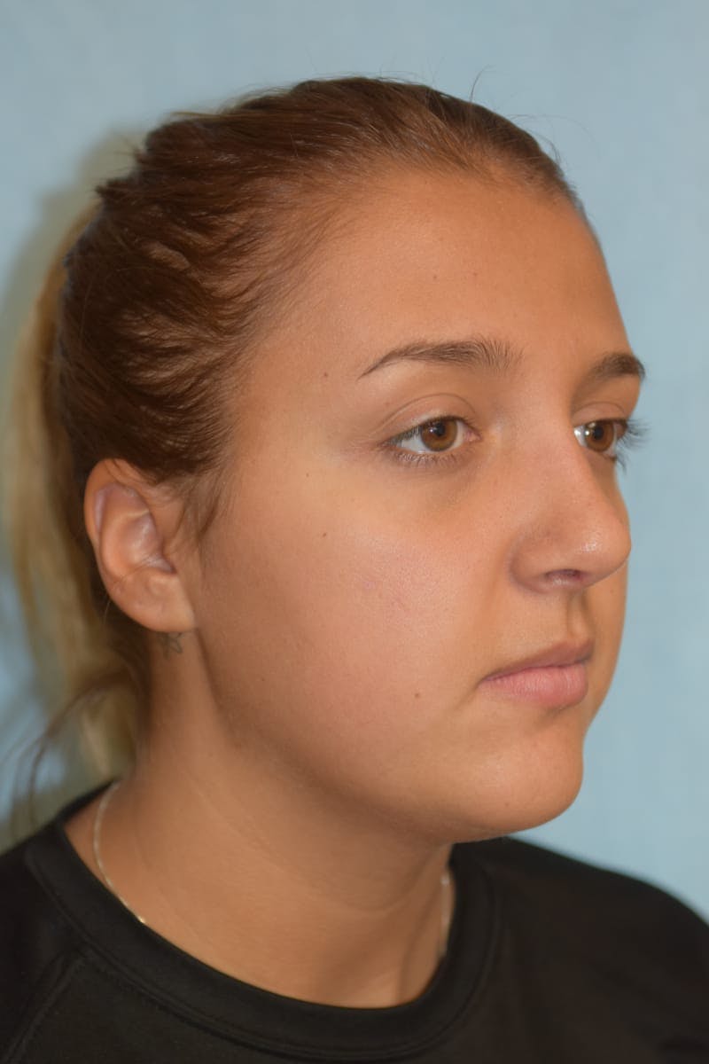 Rhinoplasty Before & After Gallery - Patient 36550413 - Image 4