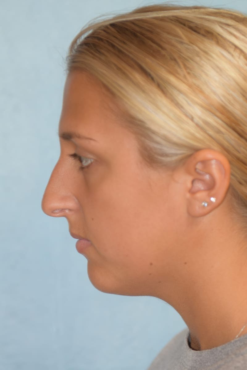 Rhinoplasty Before & After Gallery - Patient 36550413 - Image 7