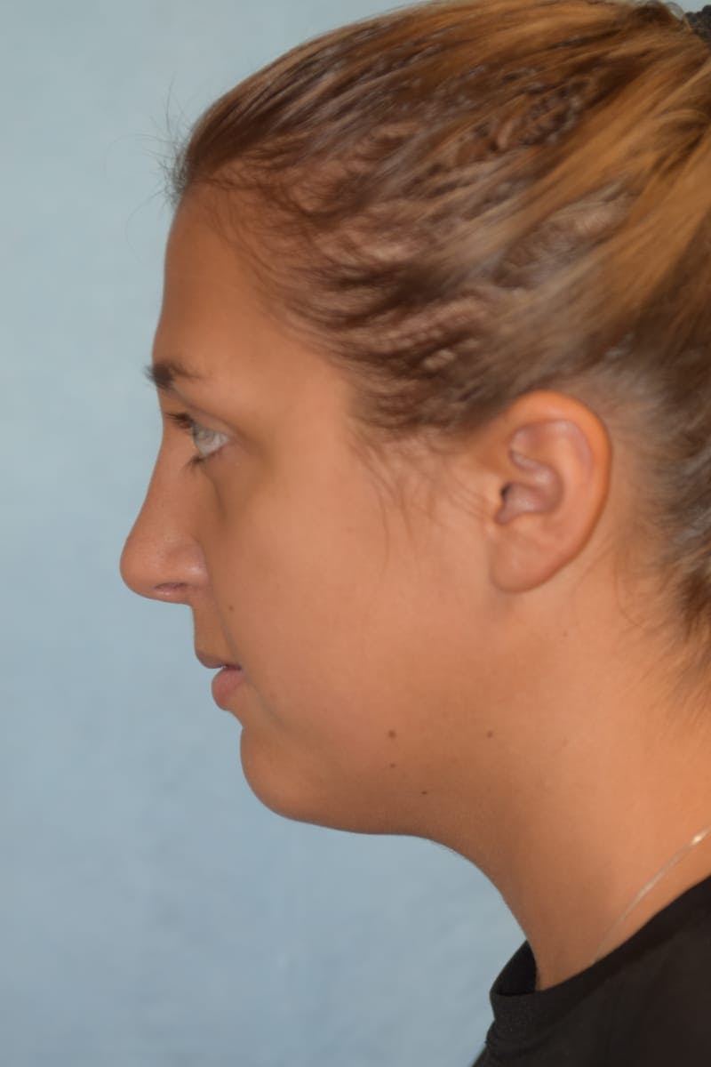 Rhinoplasty Before & After Gallery - Patient 36550413 - Image 8