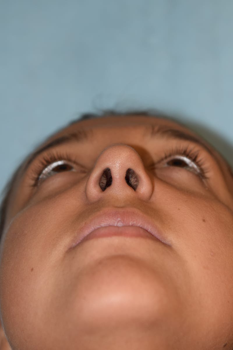 Rhinoplasty Before & After Gallery - Patient 36550413 - Image 9