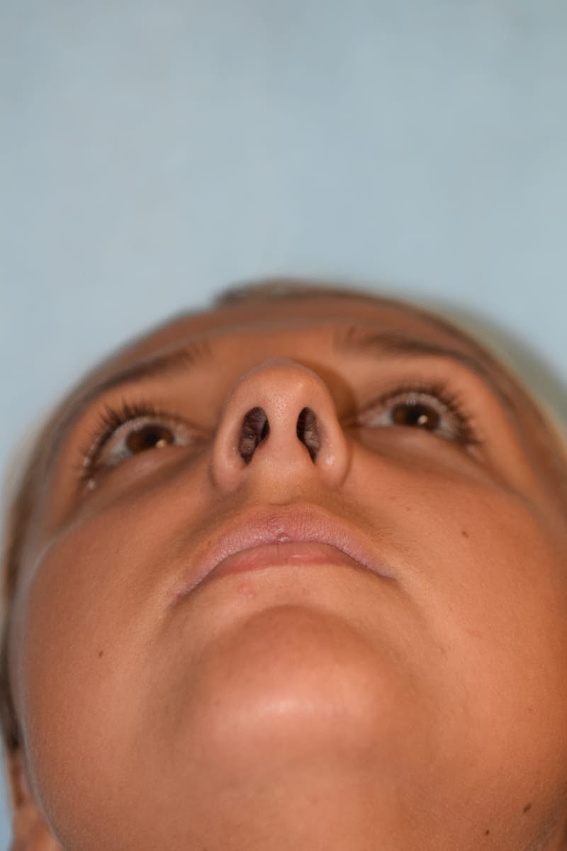Rhinoplasty Before & After Gallery - Patient 36550413 - Image 10