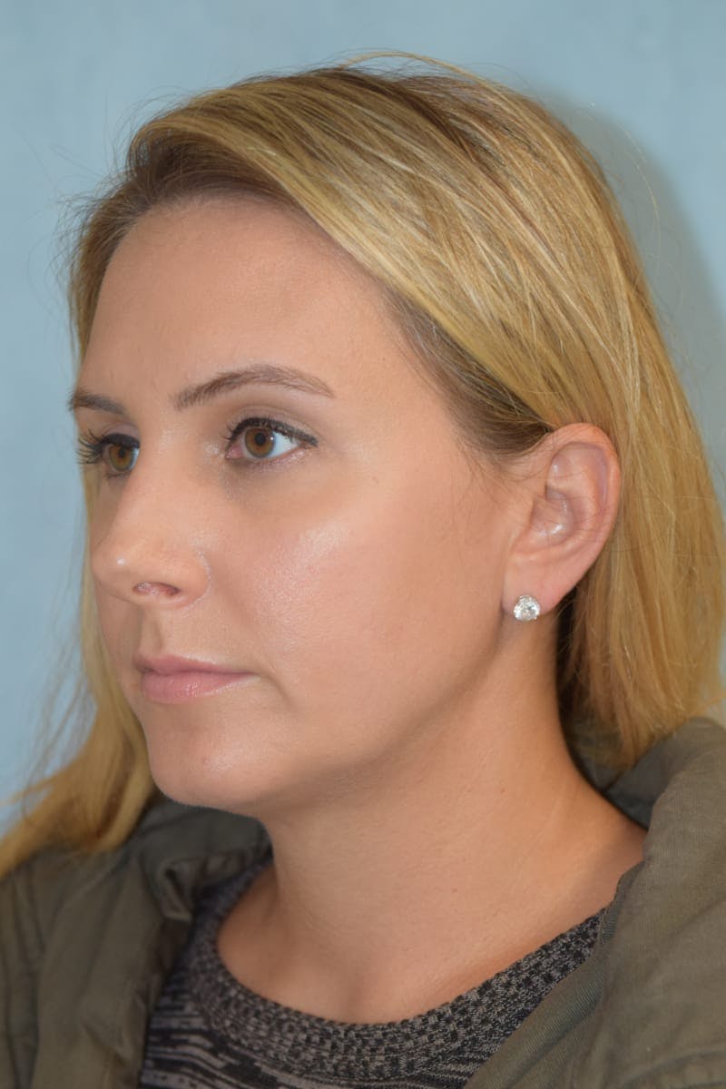 Rhinoplasty Before & After Gallery - Patient 36550406 - Image 7