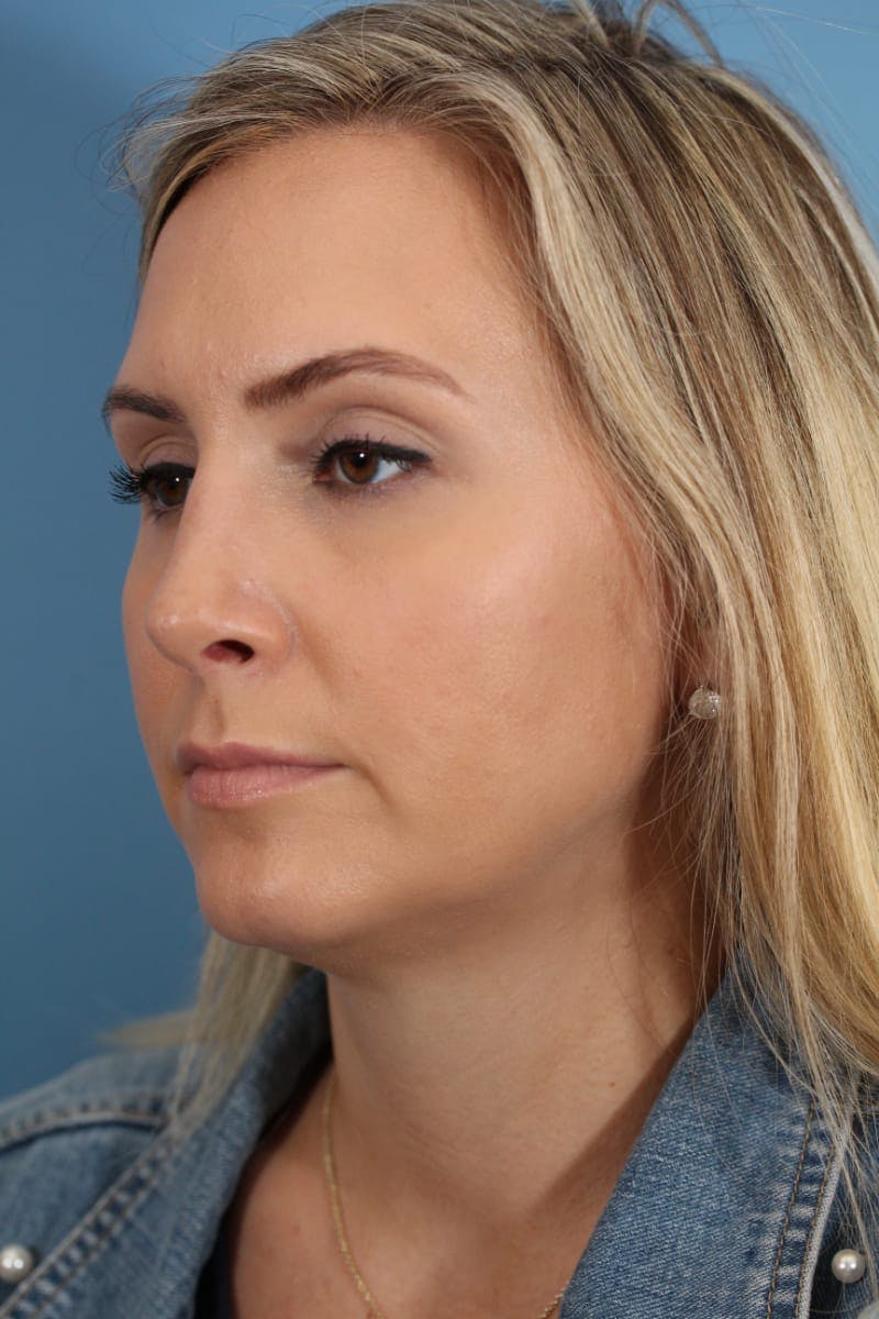 Rhinoplasty Before & After Gallery - Patient 36550406 - Image 8