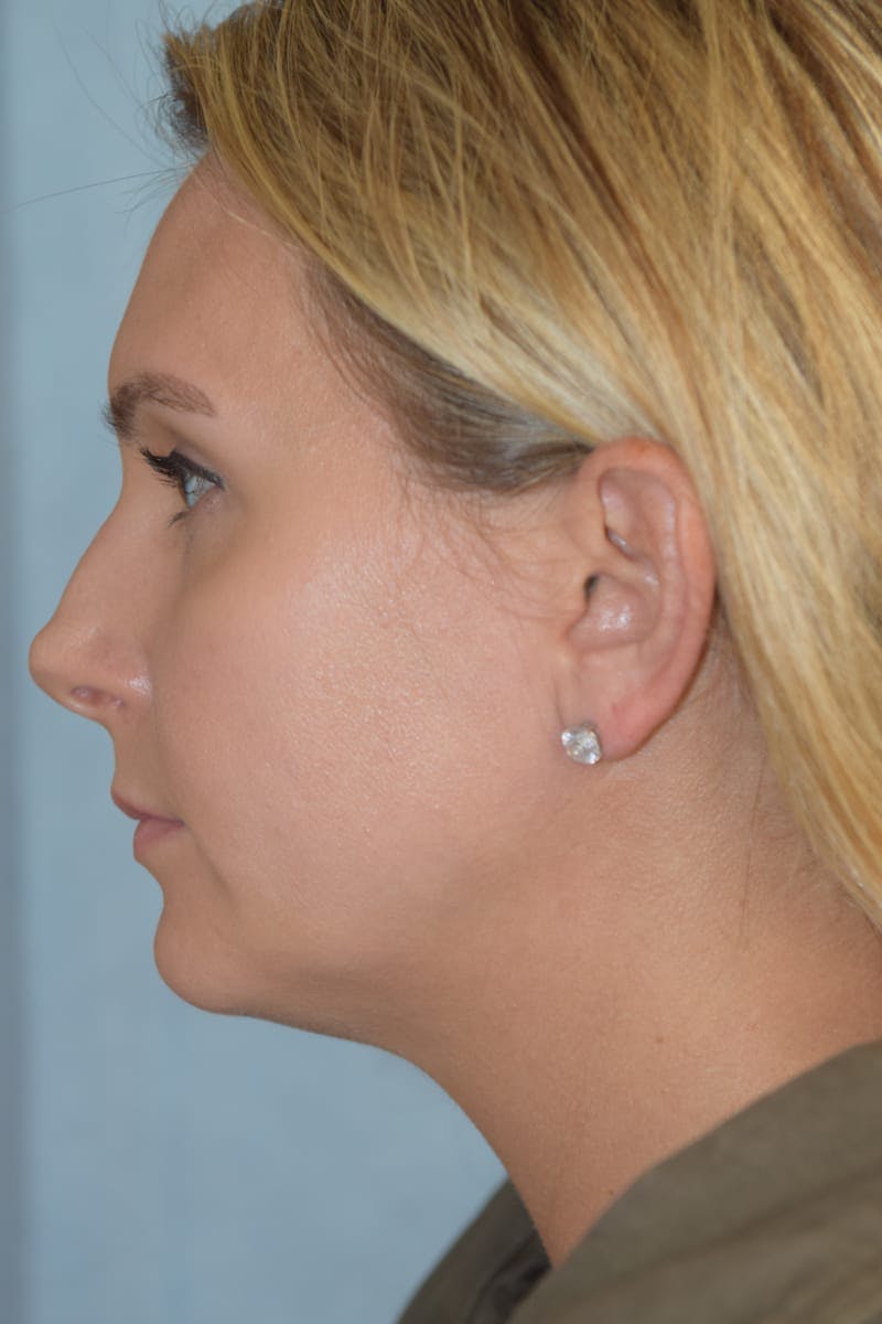 Rhinoplasty Before & After Gallery - Patient 36550406 - Image 9
