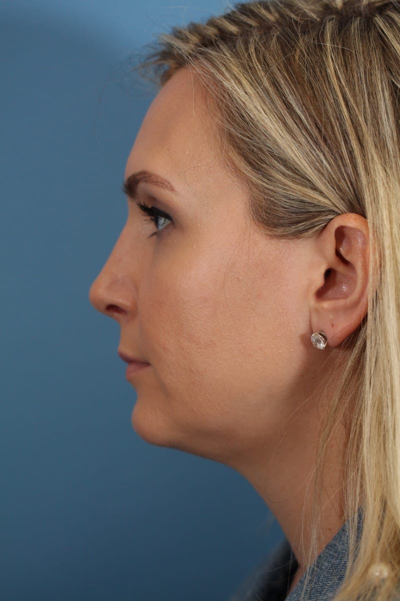 Rhinoplasty Before & After Gallery - Patient 36550406 - Image 10