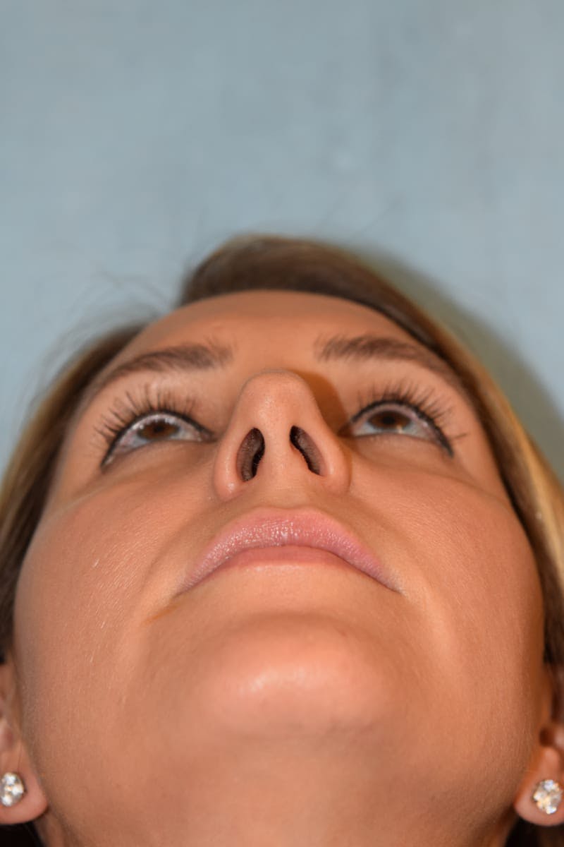 Rhinoplasty Before & After Gallery - Patient 36550406 - Image 11