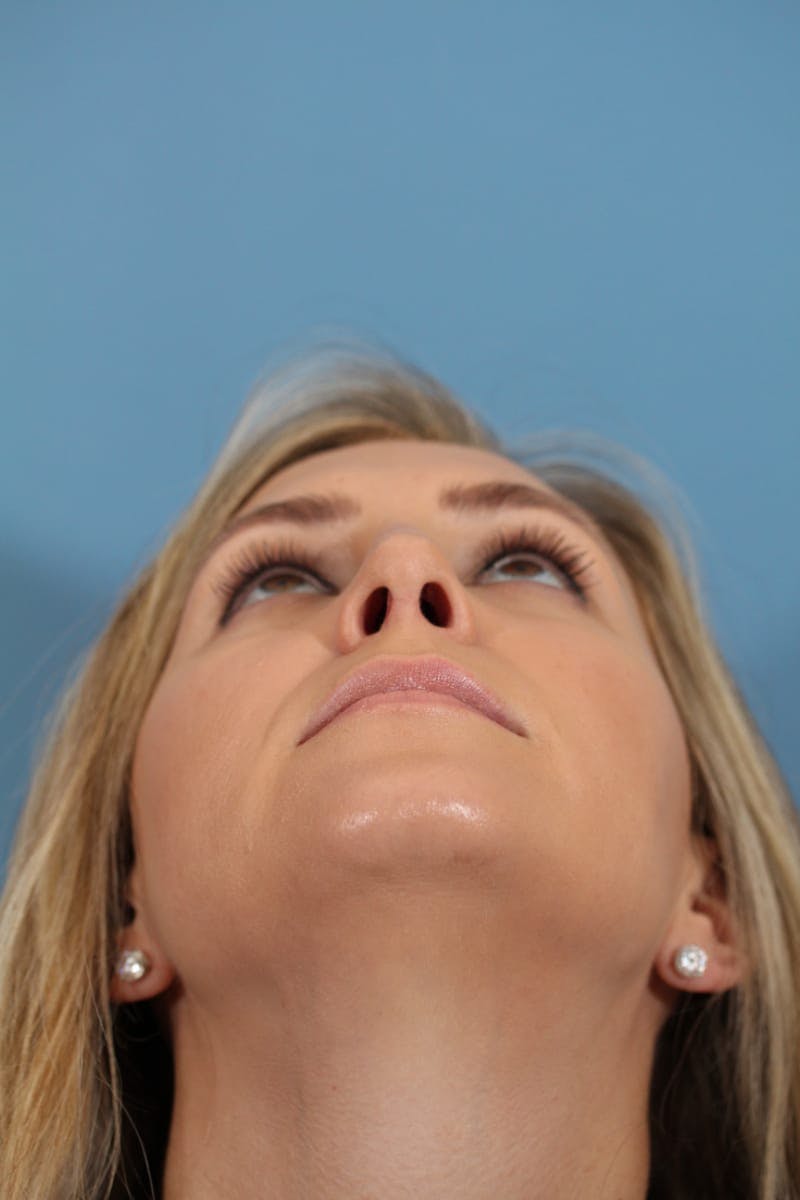 Rhinoplasty Before & After Gallery - Patient 36550406 - Image 12