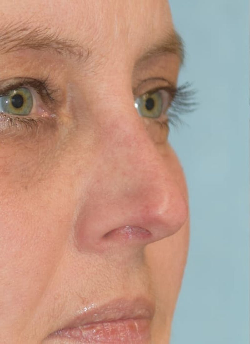 Rhinoplasty Before & After Gallery - Patient 36550400 - Image 3