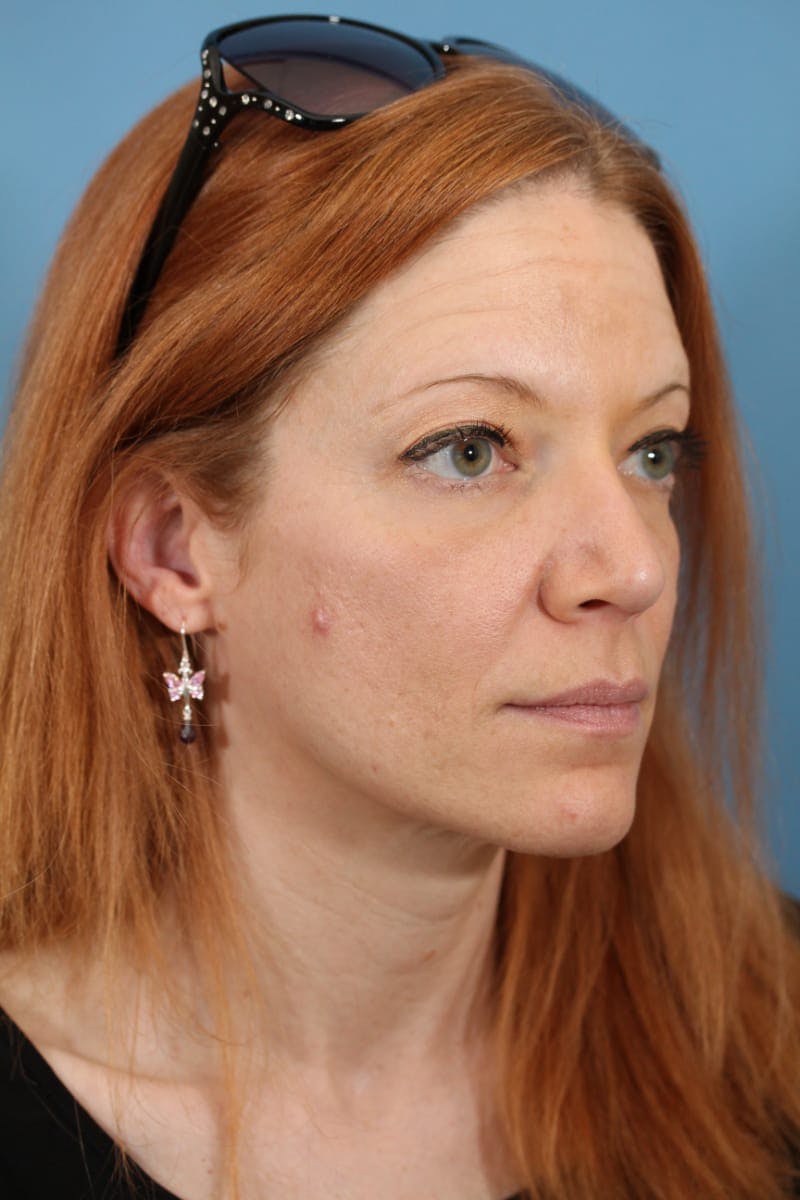 Rhinoplasty Before & After Gallery - Patient 36550411 - Image 6