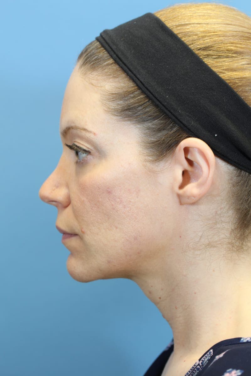 Rhinoplasty Before & After Gallery - Patient 36550411 - Image 7