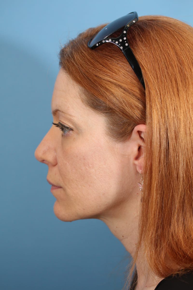 Rhinoplasty Before & After Gallery - Patient 36550411 - Image 8