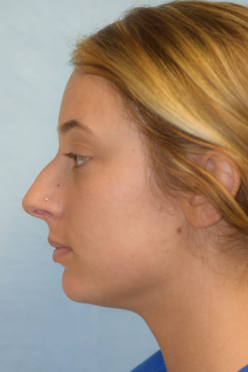 Rhinoplasty Before & After Gallery - Patient 36550410 - Image 5