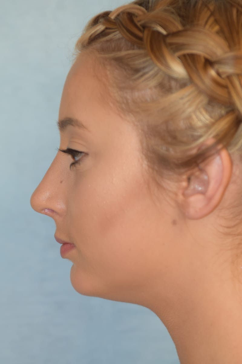 Rhinoplasty Before & After Gallery - Patient 36550410 - Image 6