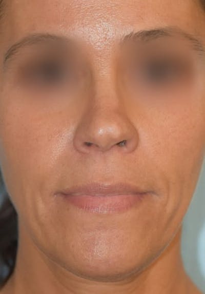 Rhinoplasty Before & After Gallery - Patient 36550399 - Image 1