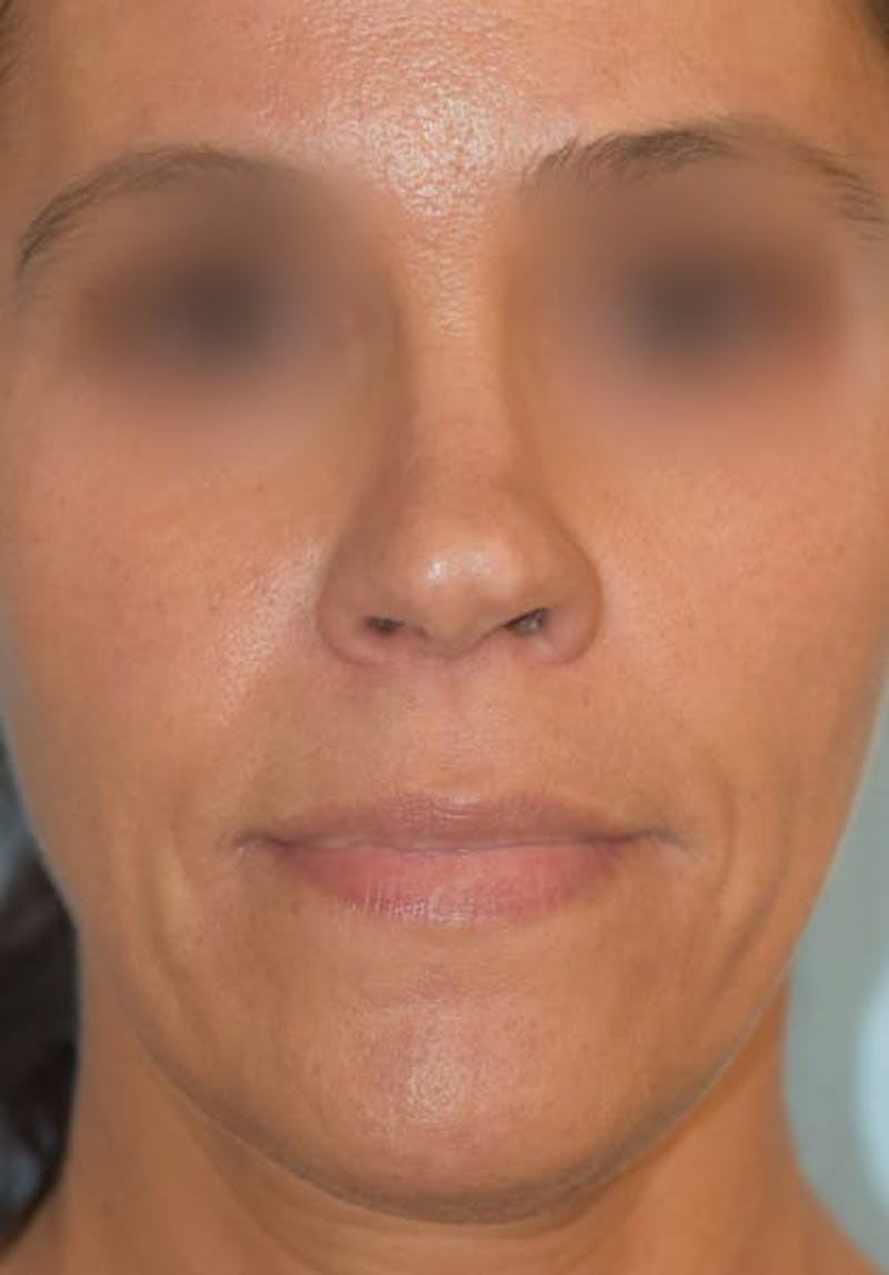 Rhinoplasty Before & After Gallery - Patient 36550399 - Image 3