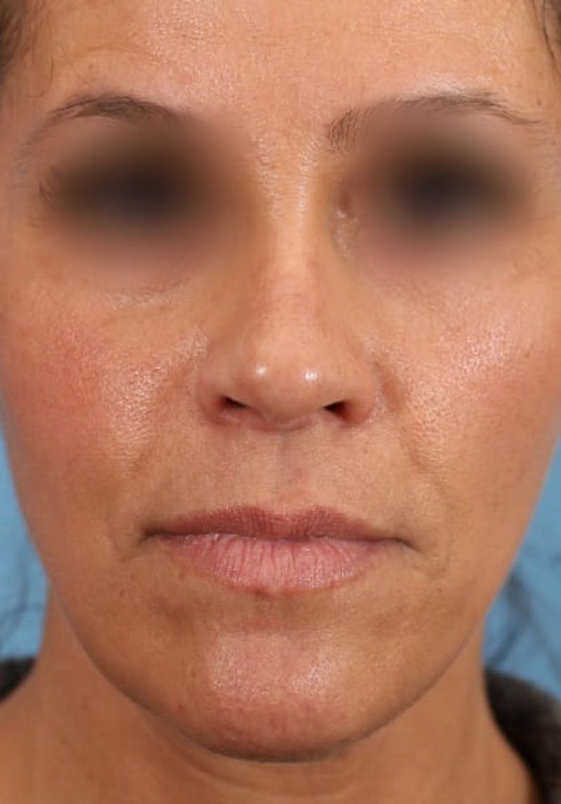 Rhinoplasty Before & After Gallery - Patient 36550399 - Image 4