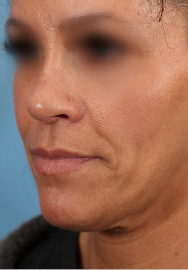 Rhinoplasty Before & After Gallery - Patient 36550399 - Image 3