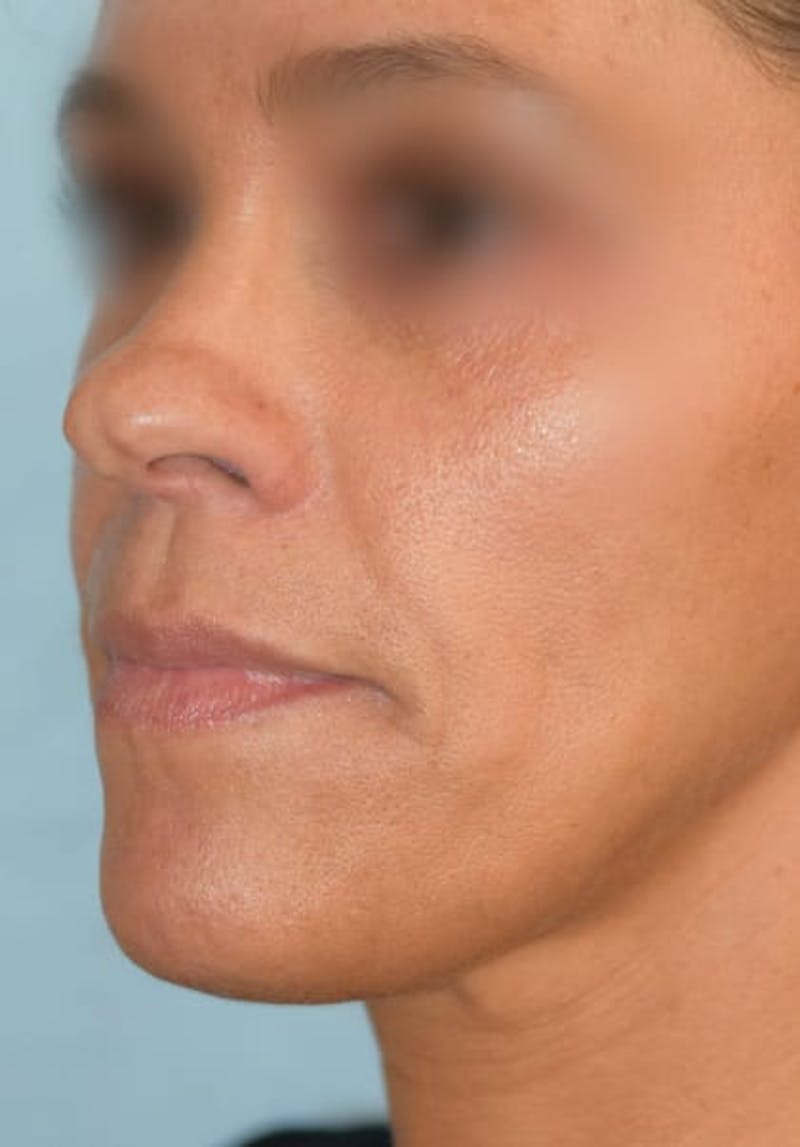 Rhinoplasty Before & After Gallery - Patient 36550399 - Image 6