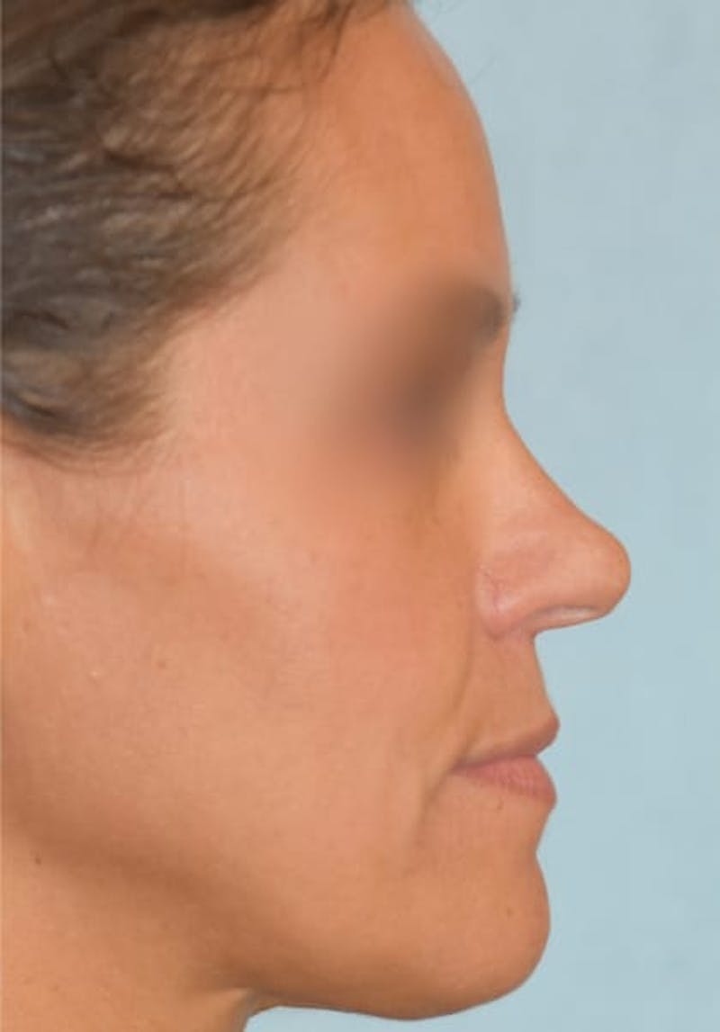 Rhinoplasty Before & After Gallery - Patient 36550399 - Image 1