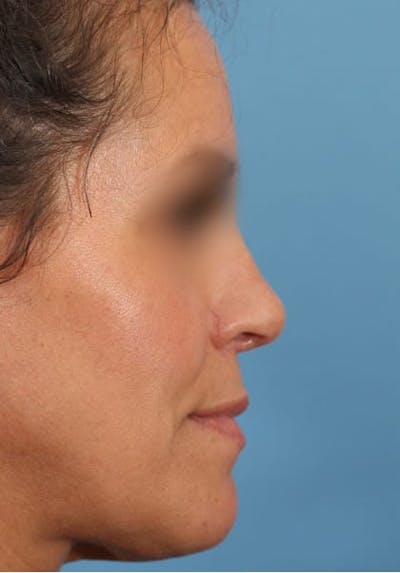 Rhinoplasty Before & After Gallery - Patient 36550399 - Image 2