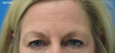 Botox Before & After Gallery - Patient 40563199 - Image 1
