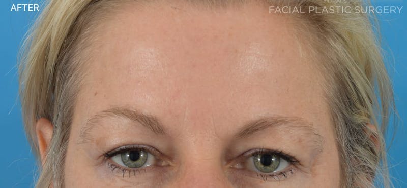 Botox Before & After Gallery - Patient 40563199 - Image 2