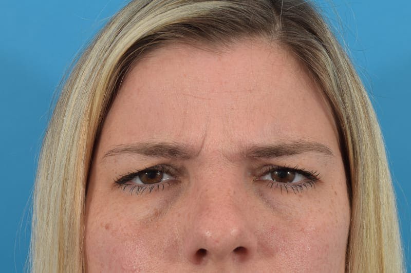 Botox Before & After Gallery - Patient 40563200 - Image 1