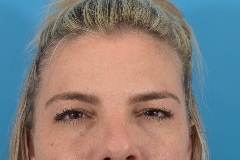 Botox Before & After Gallery - Patient 40563200 - Image 2