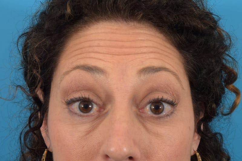 Botox Before & After Gallery - Patient 40563211 - Image 1