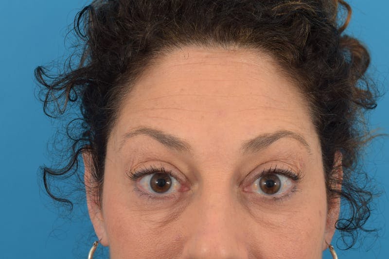Botox Before & After Gallery - Patient 40563211 - Image 2
