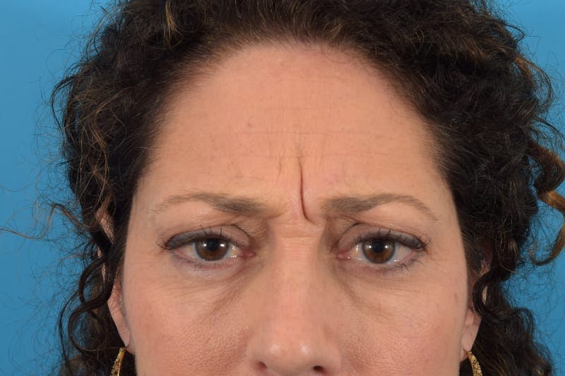 Botox Before & After Gallery - Patient 40563211 - Image 3