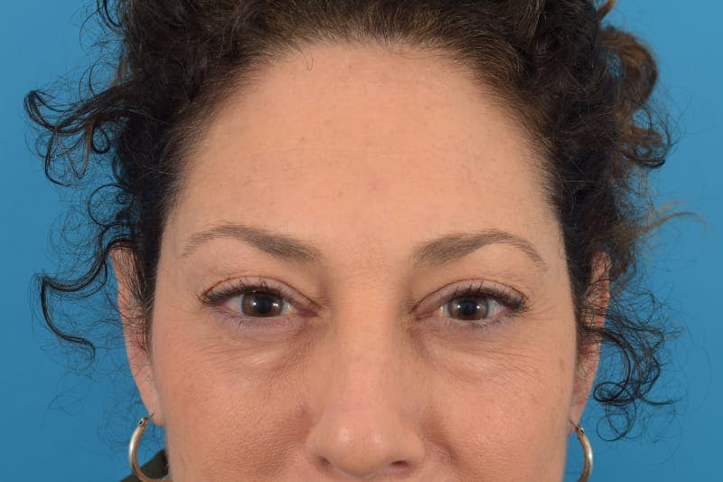 Botox Before & After Gallery - Patient 40563211 - Image 4
