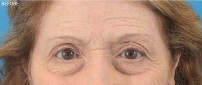 Botox Before & After Gallery - Patient 40563212 - Image 1