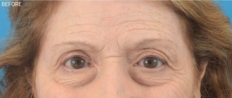 Botox Before & After Gallery - Patient 40563212 - Image 1