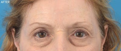 Botox Before & After Gallery - Patient 40563212 - Image 2