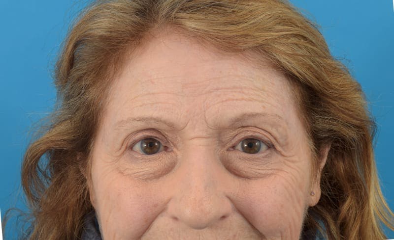 Botox Before & After Gallery - Patient 40563212 - Image 3