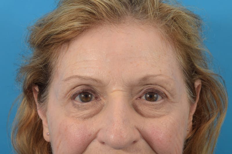 Botox Before & After Gallery - Patient 40563212 - Image 4