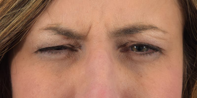 Botox Before & After Gallery - Patient 40563213 - Image 1