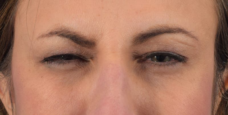 Botox Before & After Gallery - Patient 40563213 - Image 2