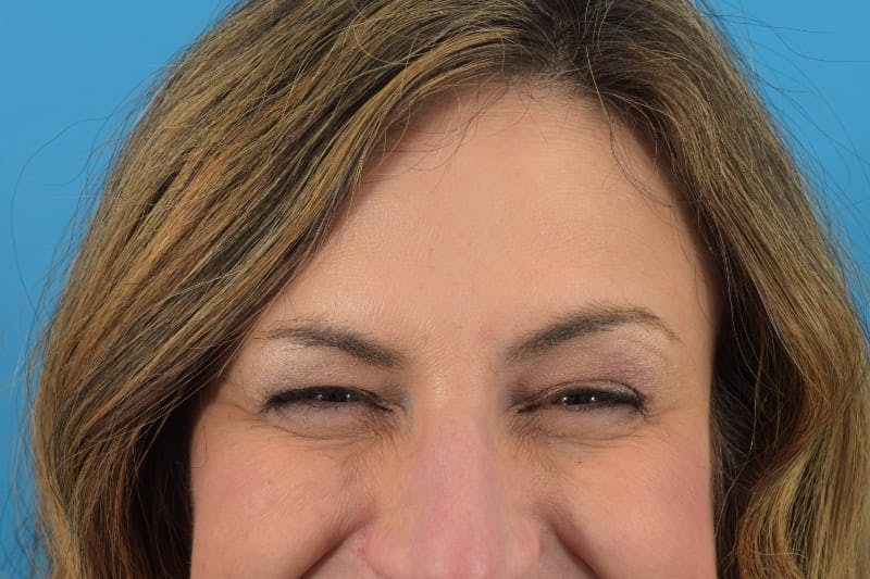 Botox Before & After Gallery - Patient 40563213 - Image 3
