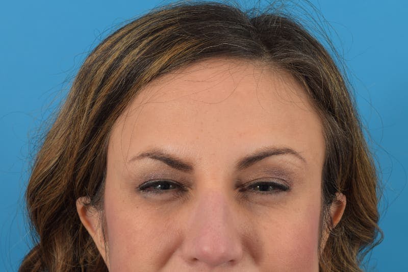 Botox Before & After Gallery - Patient 40563213 - Image 4