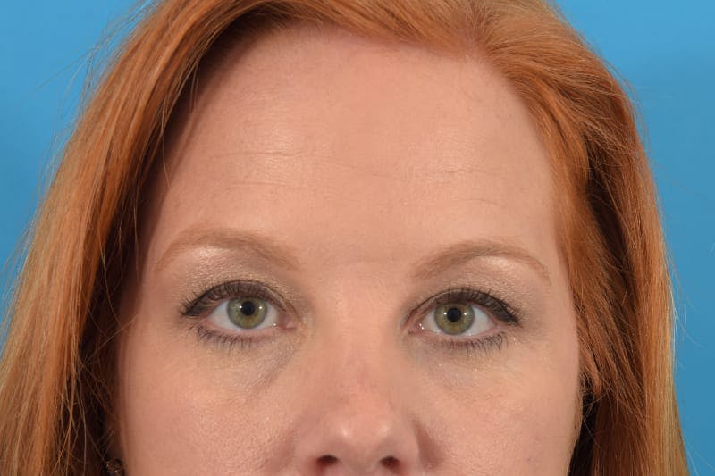 Botox Before & After Gallery - Patient 40563214 - Image 1