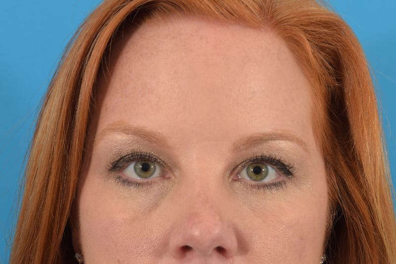 Botox Before & After Gallery - Patient 40563214 - Image 2