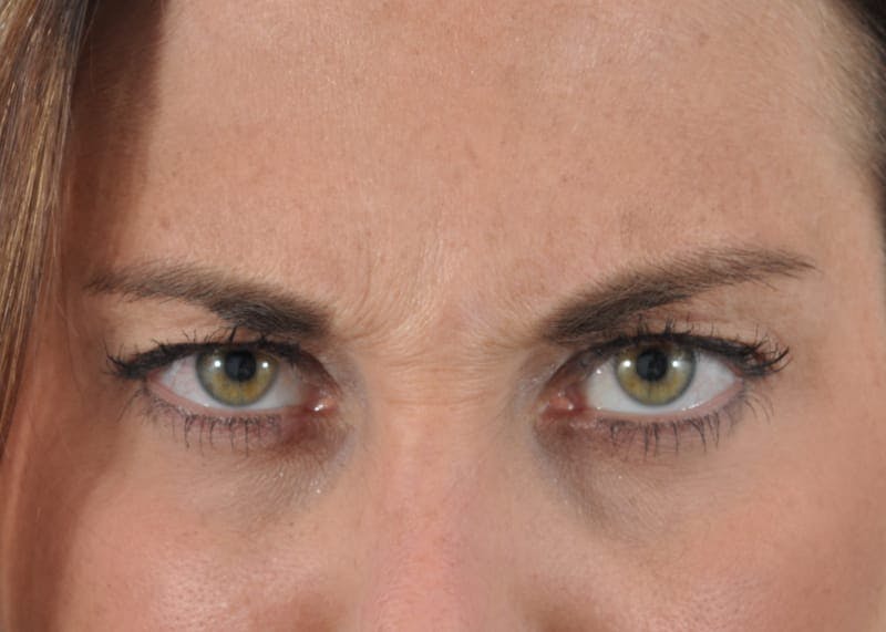 Botox Before & After Gallery - Patient 40563213 - Image 5
