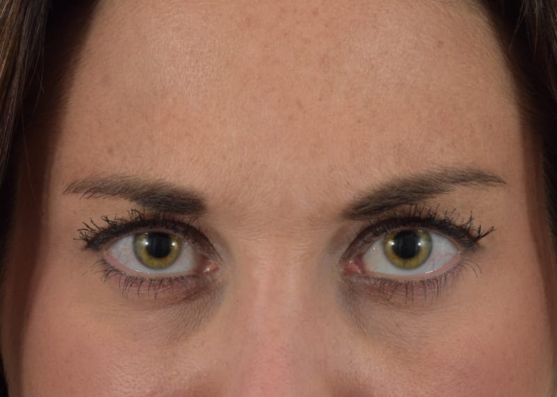Botox Before & After Gallery - Patient 40563213 - Image 6
